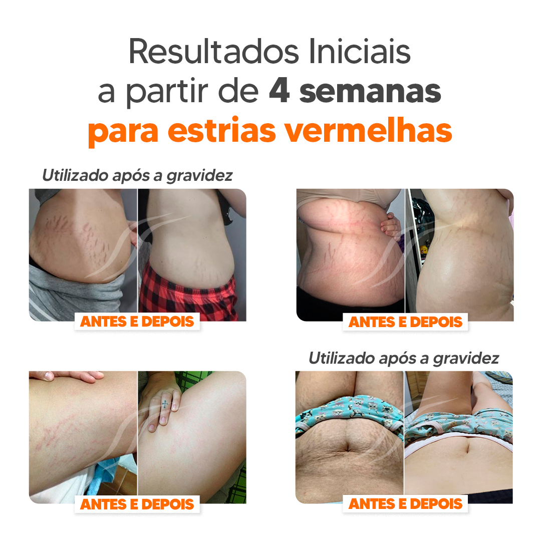 Kit CicatriSSim Creme Para Estrias 4unidades