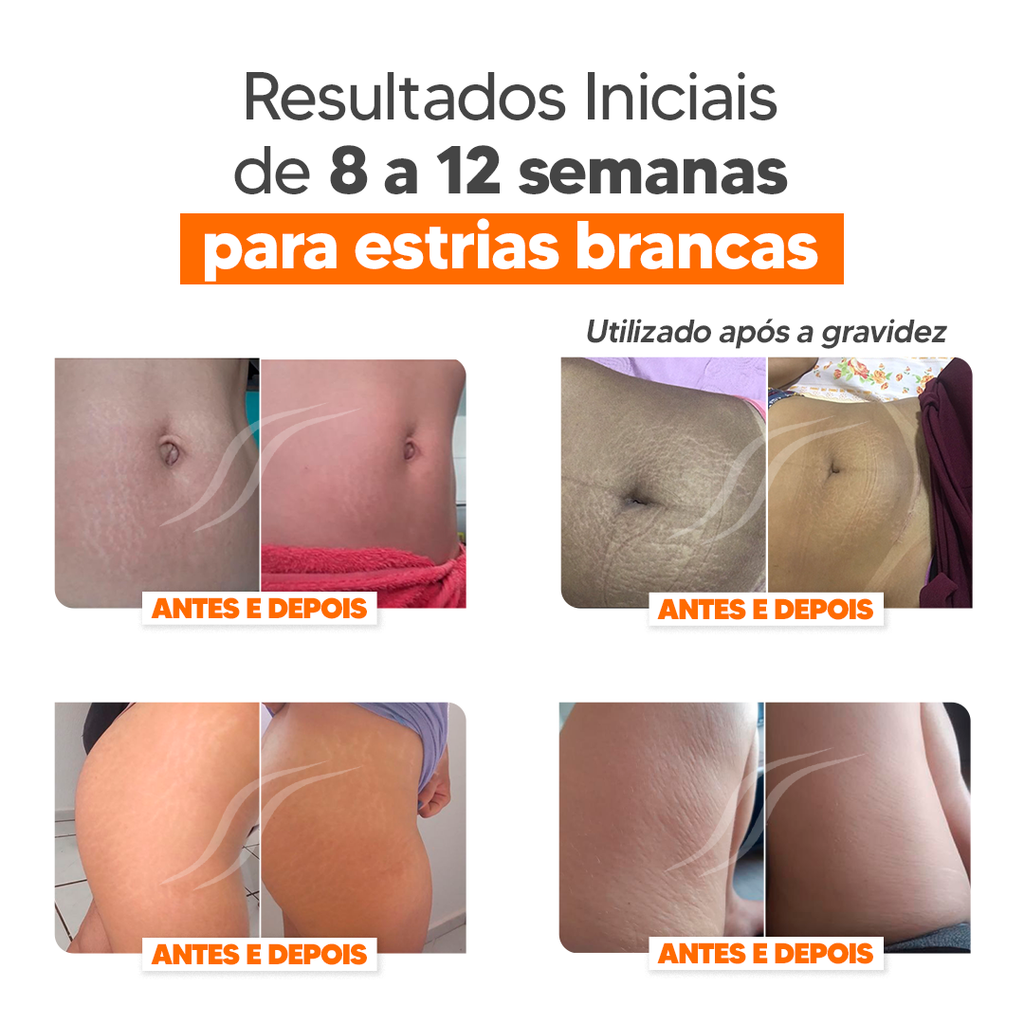 Kit CicatriSSim Creme Para Estrias 4unidades