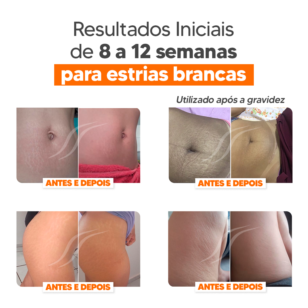 Kit CicatriSSim Creme Para Estrias 4unidades